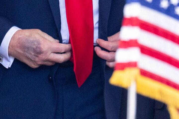 Des ecchymoses sur la main de Donald Trump ravivent les inquiétudes sur sa santé lors de sa rencontre avec le président sud-coréen