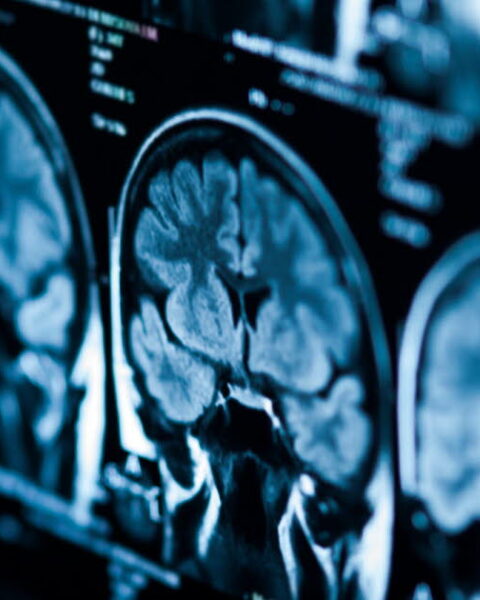 Sclérose en plaques : de nouvelles découvertes sur le rôle des cellules Tfr dans l'inflammation