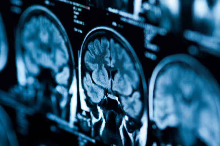 Sclérose en plaques : de nouvelles découvertes sur le rôle des cellules Tfr dans l'inflammation