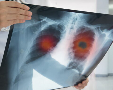 Augmentation alarmante du cancer du poumon chez les non-fumeurs en France : des causes à explorer