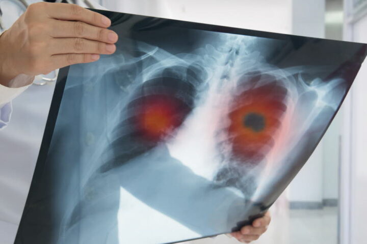 Augmentation alarmante du cancer du poumon chez les non-fumeurs en France : des causes à explorer