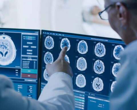 Essai clinique prometteur pour un traitement de la maladie de Huntington en France