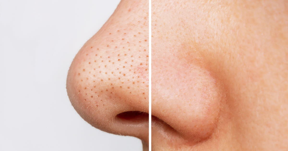 Les points noirs : pourquoi est-il déconseillé de les toucher ?