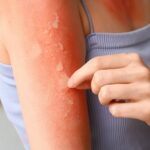 Les signes d'alerte des coups de soleil à ne pas ignorer