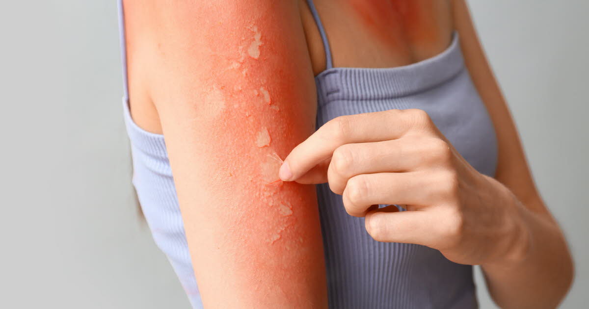 Les signes d'alerte des coups de soleil à ne pas ignorer