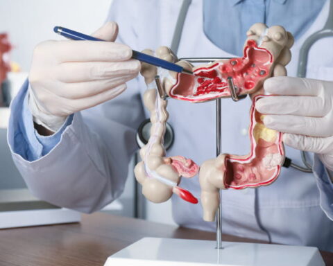 Une faible dose d'aspirine pourrait réduire de 55 % le risque de récidive du cancer du côlon en Europe