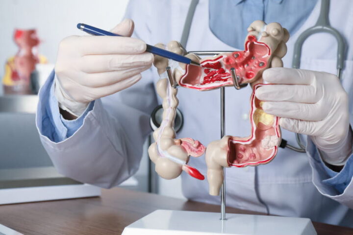 Une faible dose d'aspirine pourrait réduire de 55 % le risque de récidive du cancer du côlon en Europe