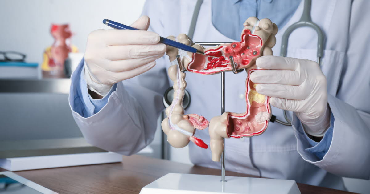 Une faible dose d'aspirine pourrait réduire de 55 % le risque de récidive du cancer du côlon en Europe