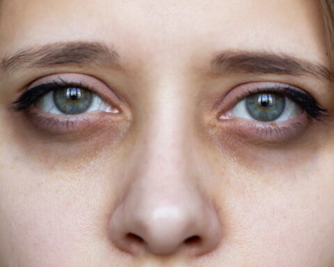 Comprendre les causes des cernes sous les yeux et les solutions pour les atténuer