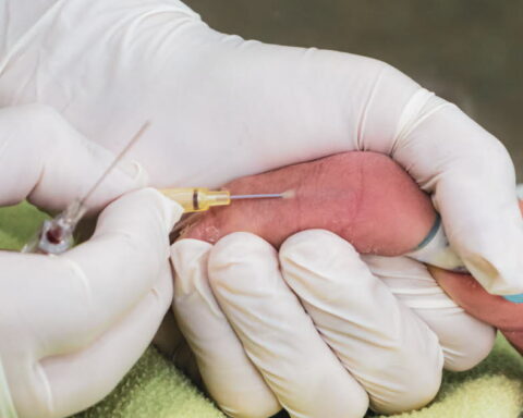 Dépistage néonatal : deux nouvelles maladies recommandées par la HAS pour protection des enfants