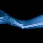 Des chercheurs développent une colle innovante pour réparer rapidement les fractures osseuses