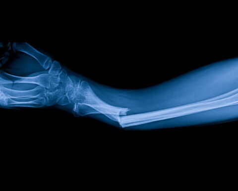 Des chercheurs développent une colle innovante pour réparer rapidement les fractures osseuses