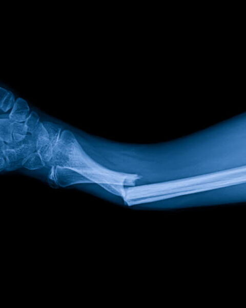 Des chercheurs développent une colle innovante pour réparer rapidement les fractures osseuses
