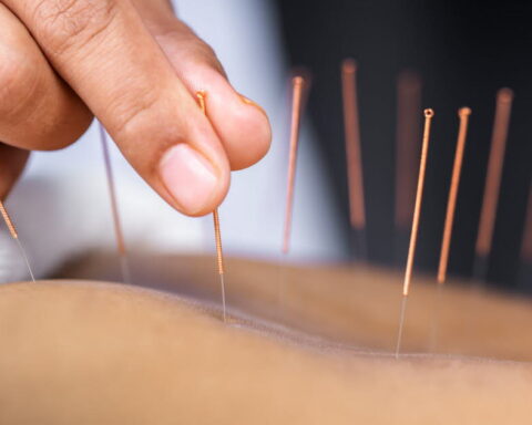 L'acupuncture : un champ d'études cliniques contesté par la médecine conventionnelle en France