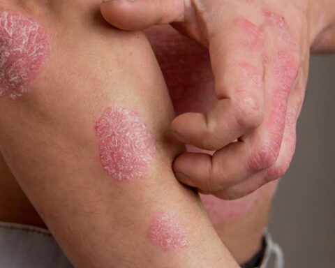 Le psoriasis : une maladie de la peau souvent liée à d'autres pathologies en France