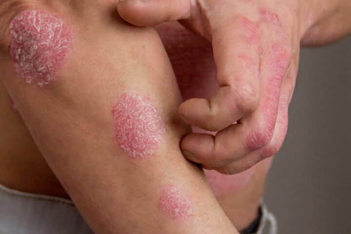 Le psoriasis : une maladie de la peau souvent liée à d'autres pathologies en France