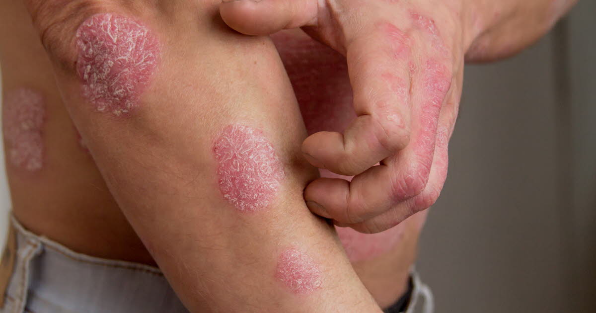 Le psoriasis : une maladie de la peau souvent liée à d'autres pathologies en France