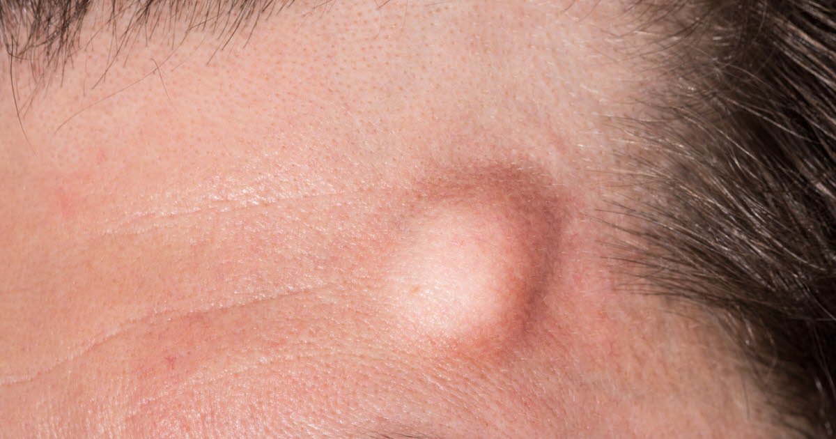 Les mécanismes de formation des bosses après un choc à la tête