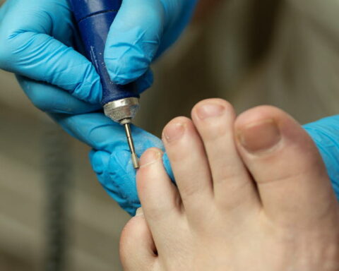 Quand consulter un podologue pour les ongles incarnés et les troubles circulatoires ?