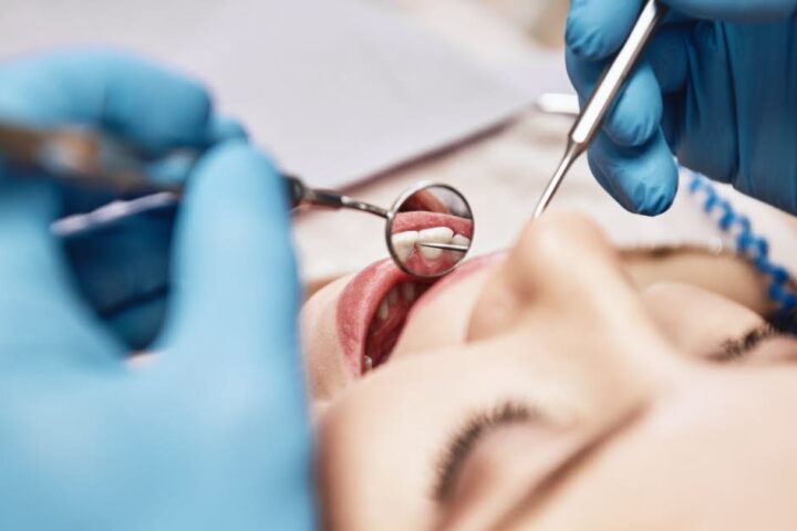 Une mauvaise santé bucco-dentaire augmente-t-elle le risque d’AVC selon une étude américaine ?