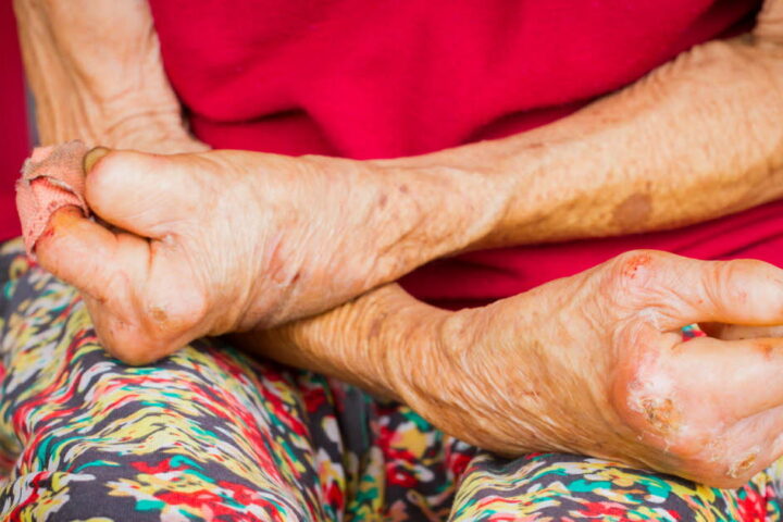 La lèpre réapparaît en Europe avec deux cas confirmés en Roumanie