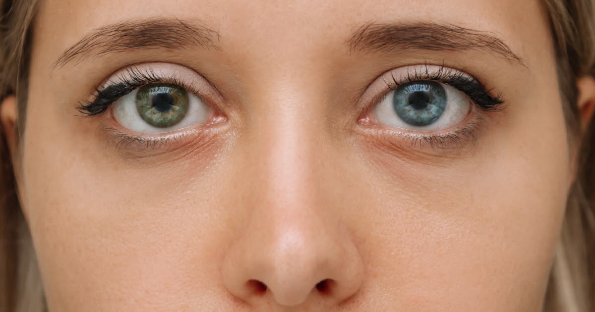 L'hétérochromie : pourquoi certaines personnes ont des yeux de couleurs différentes