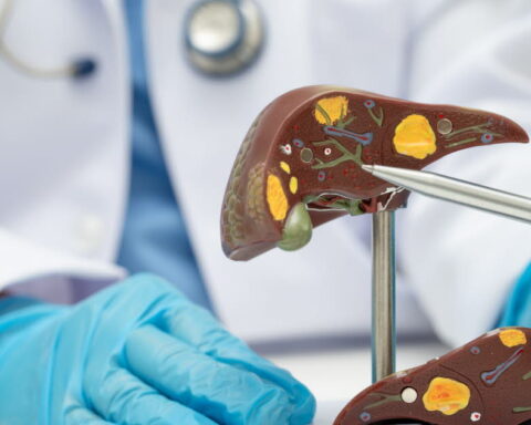 Maladie du foie gras : une pandémie silencieuse préoccupant la santé publique en France