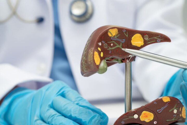 Maladie du foie gras : une pandémie silencieuse préoccupant la santé publique en France