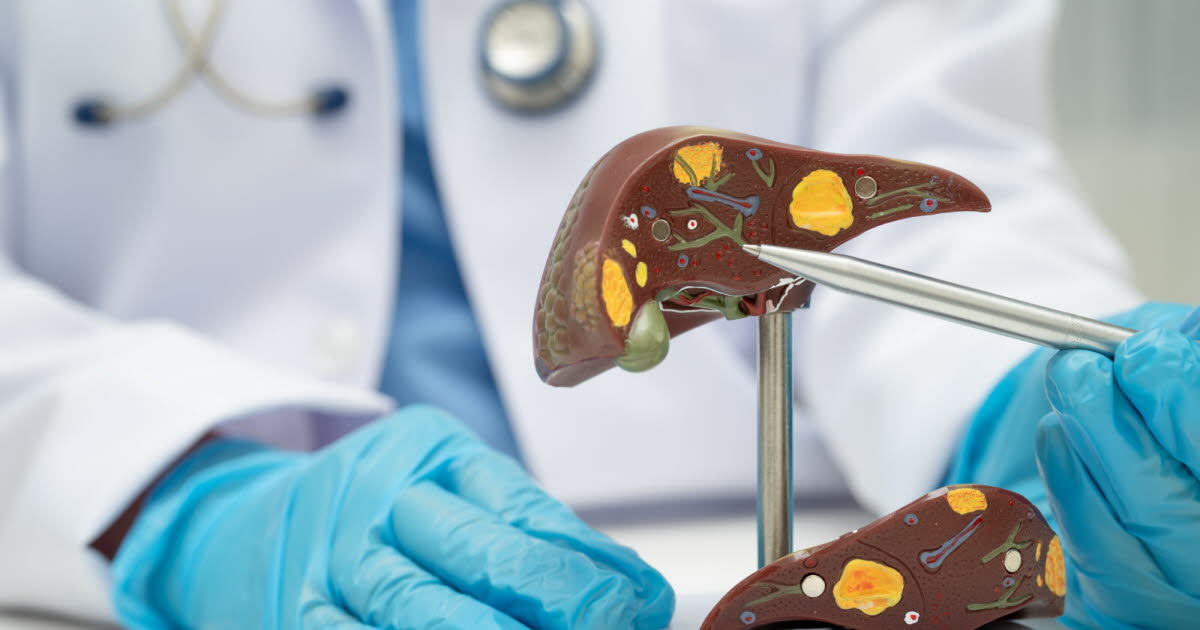 Maladie du foie gras : une pandémie silencieuse préoccupant la santé publique en France