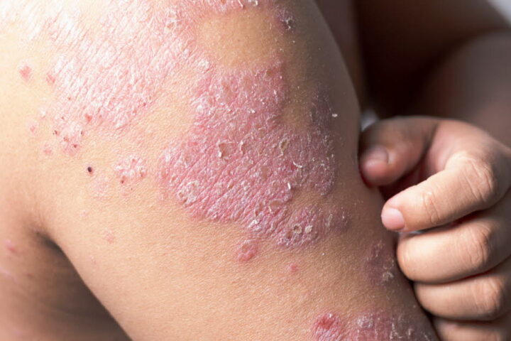 Six nouveaux biomédicaments pour traiter la dermatite atopique en France