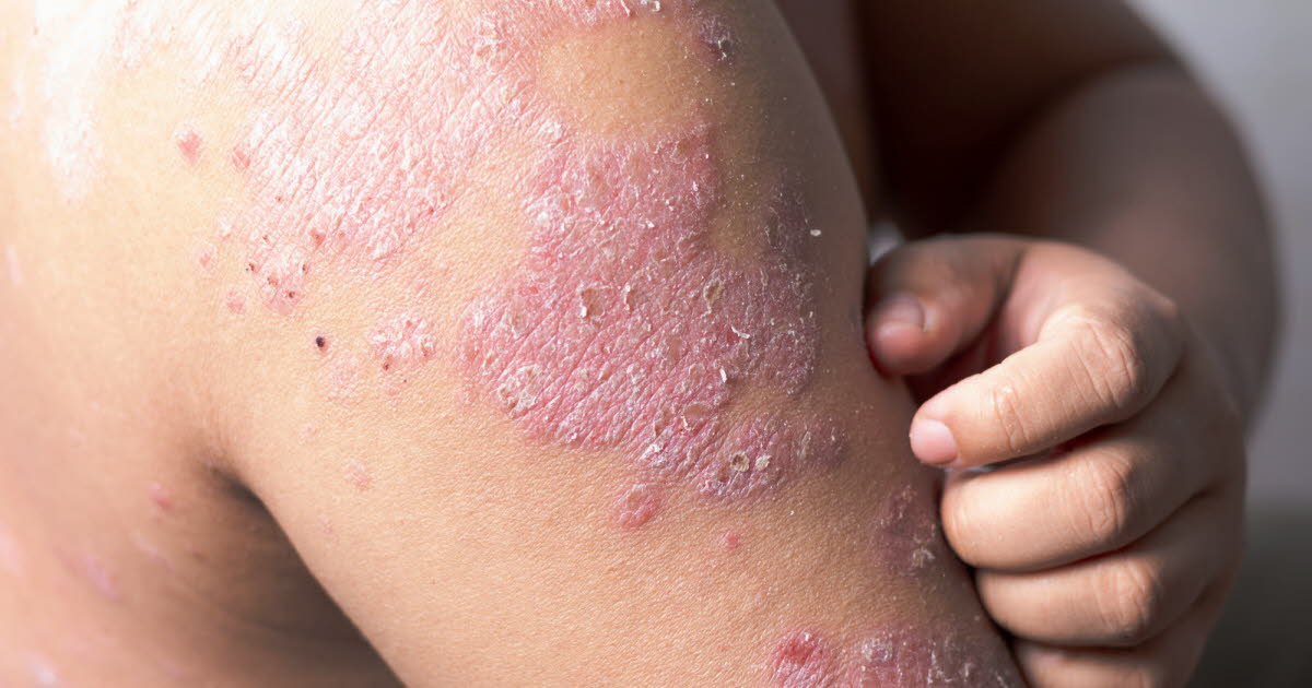 Six nouveaux biomédicaments pour traiter la dermatite atopique en France