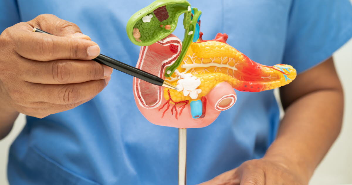 Des scientifiques développent une trithérapie prometteuse contre le cancer du pancréas chez la souris