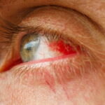 Emmanuel Macron présente des signes d'hémorragie sous-conjonctivale lors du sommet de Davos