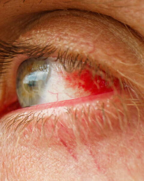 Emmanuel Macron présente des signes d'hémorragie sous-conjonctivale lors du sommet de Davos