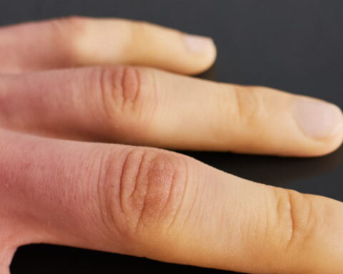 La maladie de Raynaud : des doigts qui changent de couleur par temps froid