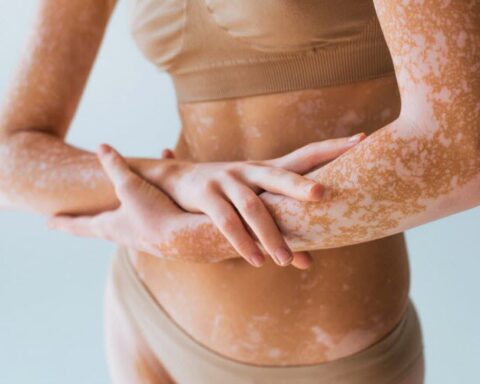 Le vitiligo : une maladie auto-immune méconnue qui touche un million de personnes en France