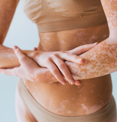 Le vitiligo : une maladie auto-immune méconnue qui touche un million de personnes en France