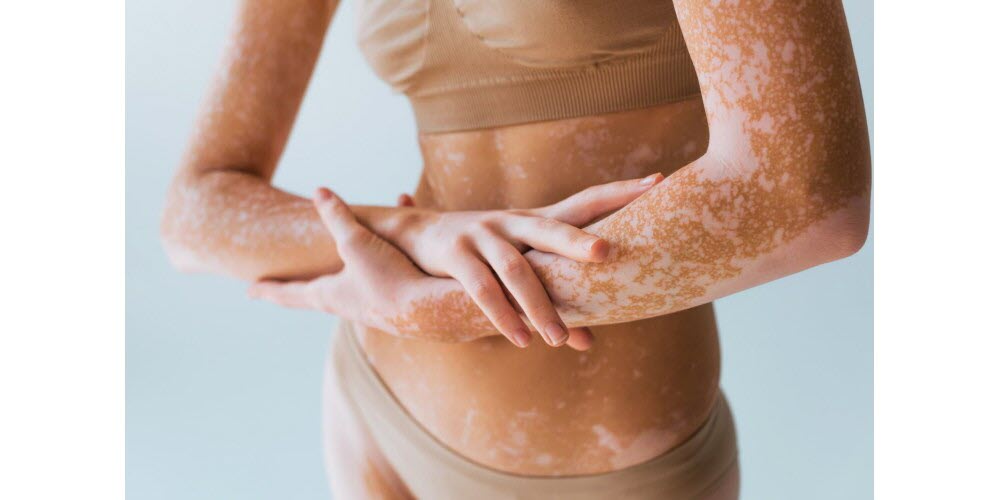 Le vitiligo : une maladie auto-immune méconnue qui touche un million de personnes en France