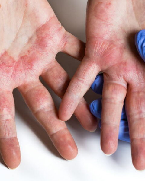 L'eczéma chronique des mains : des douleurs entravent la vie professionnelle de nombreux patients