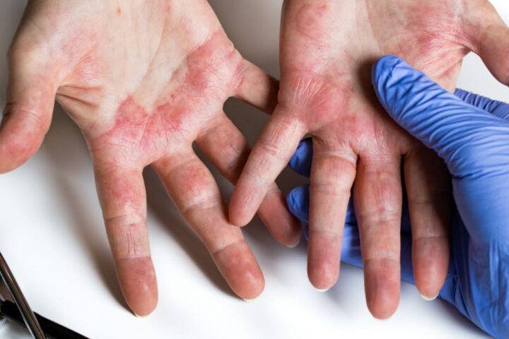 L'eczéma chronique des mains : des douleurs entravent la vie professionnelle de nombreux patients