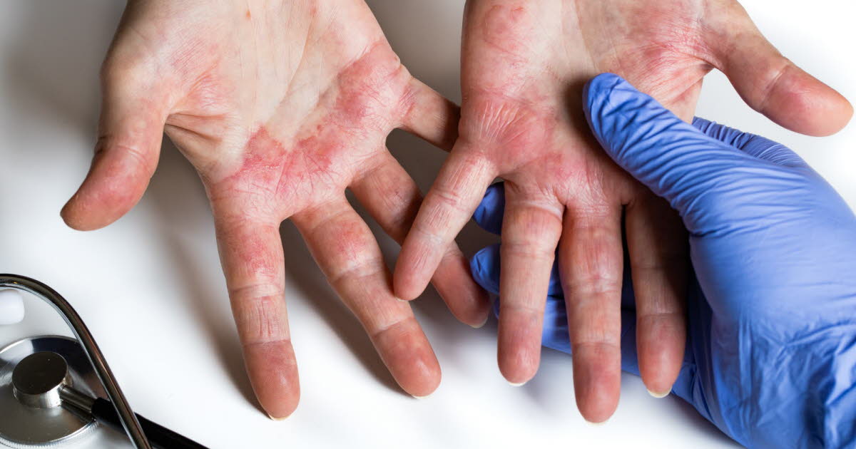 L'eczéma chronique des mains : des douleurs entravent la vie professionnelle de nombreux patients