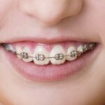 Non, les anciens ne portaient pas d'appareils dentaires, un mythe à déconstruire