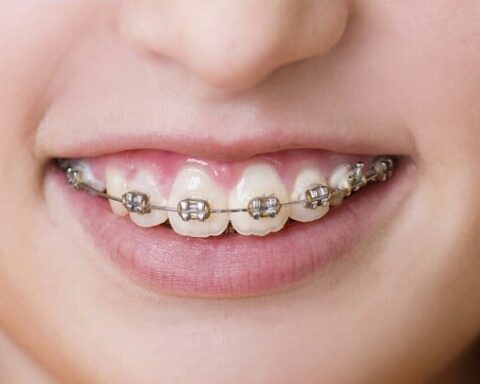 Non, les anciens ne portaient pas d'appareils dentaires, un mythe à déconstruire