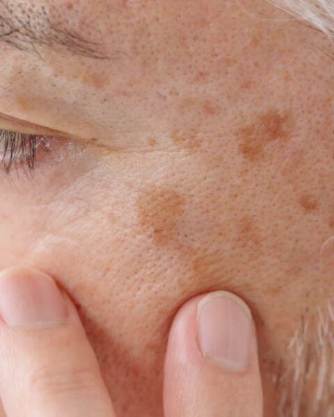 Prévenir l'apparition des taches de vieillesse sur la peau en vieillissant ?
