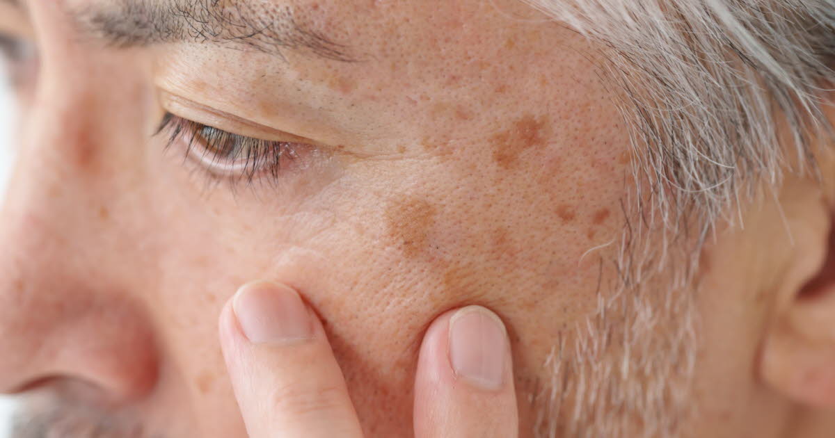 Prévenir l'apparition des taches de vieillesse sur la peau en vieillissant ?