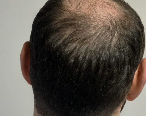 L’ANSM renforce la réglementation sur le finastéride en raison des risques suicidaires