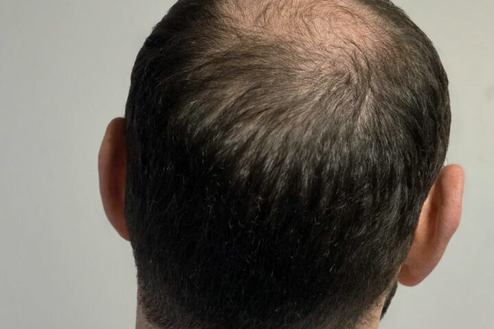 L’ANSM renforce la réglementation sur le finastéride en raison des risques suicidaires