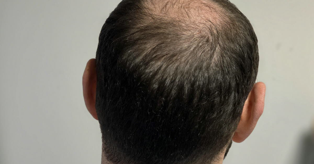 L’ANSM renforce la réglementation sur le finastéride en raison des risques suicidaires