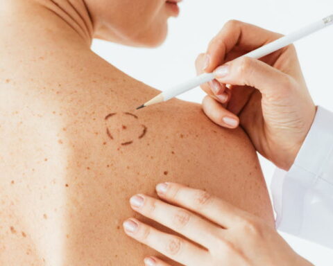 Mélanome en France : 18 000 nouveaux cas annuels et avancées dans le dépistage et le traitement