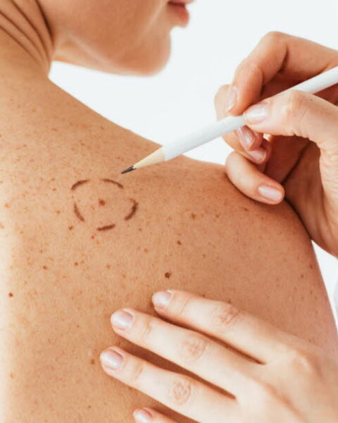 Mélanome en France : 18 000 nouveaux cas annuels et avancées dans le dépistage et le traitement